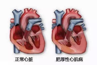 杭州男子40岁开始跑马拉松，跑步瘦身10年，一次晕倒后查出得了心脏病，医生说：跑步跑出来的