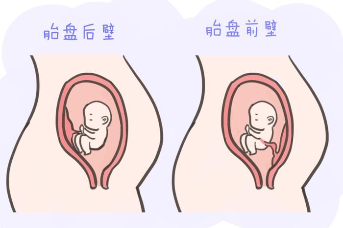胎盘前壁和后壁，意味着胎儿的状态不同，面临的风险也不一样
