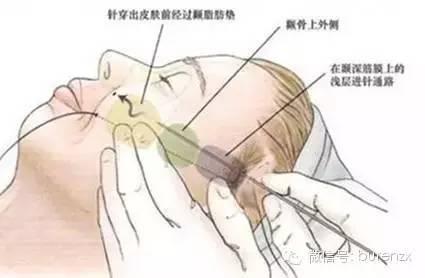 线雕手术图