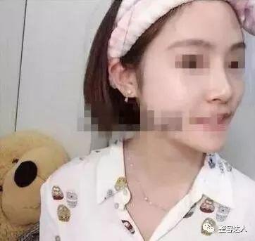 术后三个月