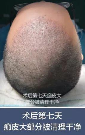 术后七天