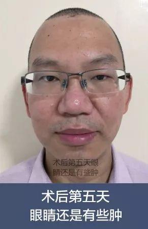 术后五天