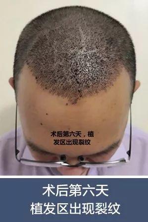 术后六天