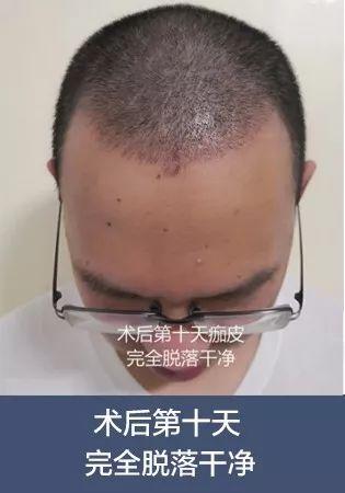 术后十天