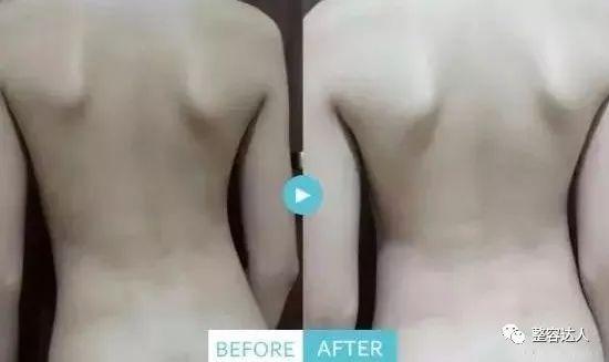 背部案例