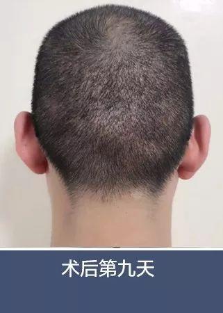 术后九天