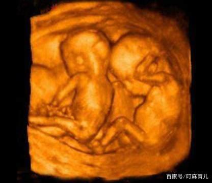 怀双胞胎有什么感觉？跟单胎有什么不同？这些信息孕妇要搞清楚
