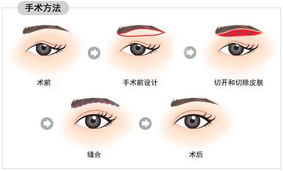 接切眉术