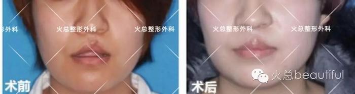 正面