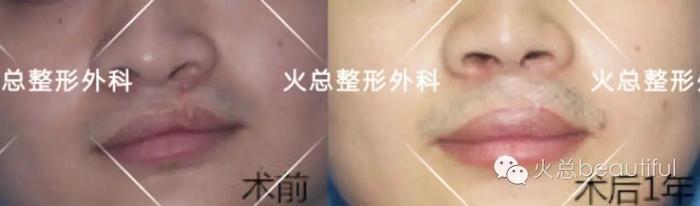 鼻唇畸形