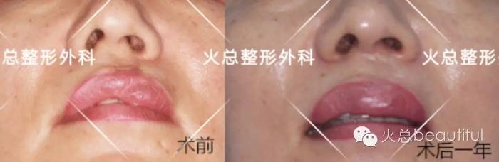 右侧鼻唇畸形