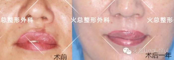 右侧鼻唇畸形