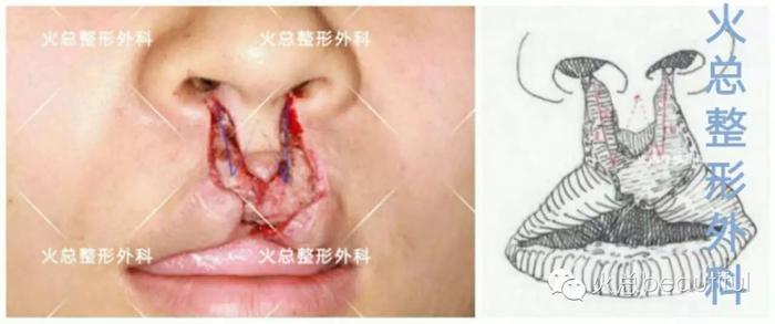 皮下组织瓣设计