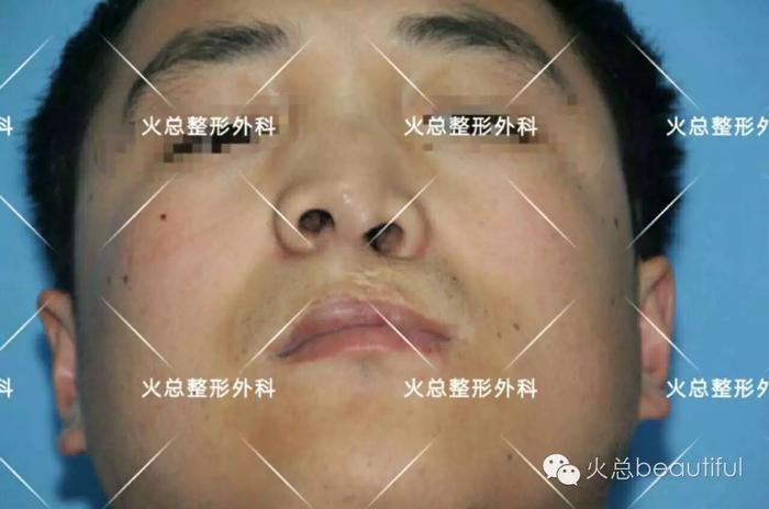 鼻翼塌陷