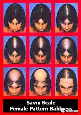 女性脱发评级,图自hairtransplantmentor.com