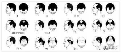男性脱发评级,图自hairtransplantmentor.com