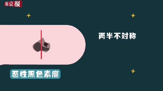 还能“点痣”吗？他抠了下痣最后成了恶性瘤