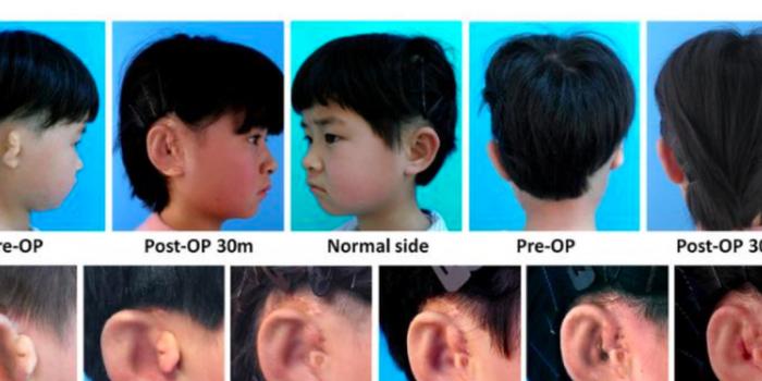 中国科学家利用3D打印技术为先天性耳朵畸形