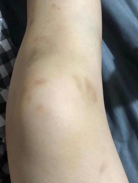 女学员腿上的伤疤。受访者供图