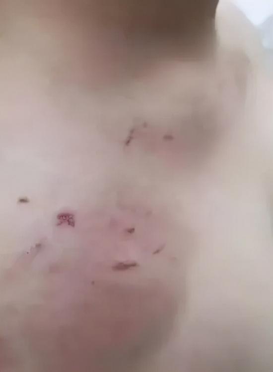 男学员胸口的伤痕。受访者供图