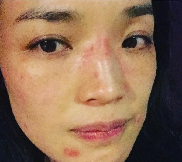 舒淇素颜过敏照
