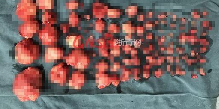 台州女子来例假血崩 医生打开子宫现110多颗肌