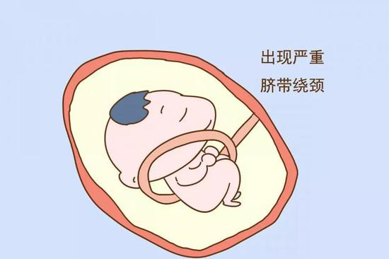 胎儿出现严重脐带绕颈