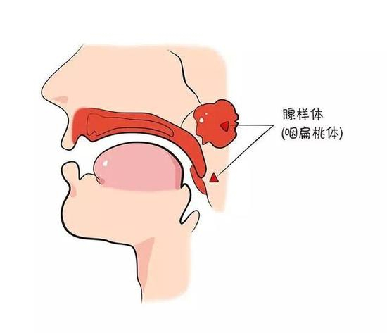 有些时候，腺样体能坚守住，有些时候嘛就一起失守了，你前脚肿大我后脚跟上。