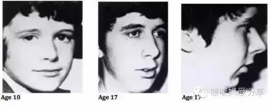 而形成这种面相的元凶，就是极容易被家长们忽视的“腺样体肥大”！