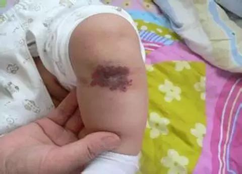 宝宝的这些痣和胎记要不要去除呢？看完你就知道了！