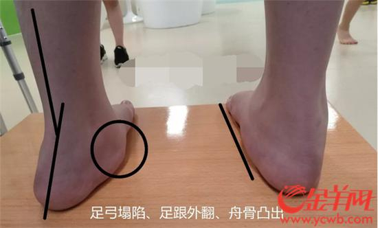 足跟外翻