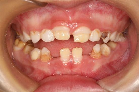 牙釉质发育缺陷性疾病(Developmental defects of enamel, DDE)
