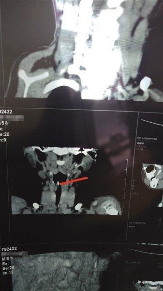 4月7日，星元医院CT结果显示，软管目前位于小白颈部左侧腮腺内。 本版图片/受访者供图