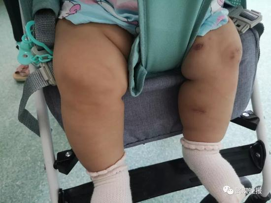 半岁宝宝被恶犬叼走咬穿颅骨