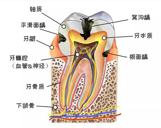 图：窝沟龋就是指发生在后牙窝沟点隙的龋坏（龋齿中的损坏）