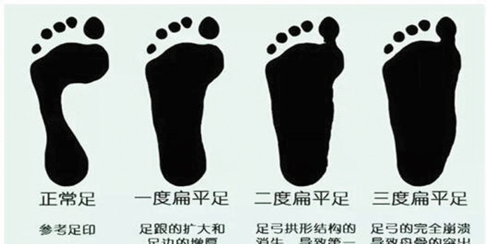 如何判断孩子是否扁平足?扁平足怎么办?
