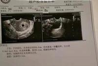 男子结扎3个月后妻子却怀孕了 卫生局回应