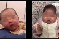 "女婴用抑菌霜变大脸娃"接诊医生:接触外源激素导致