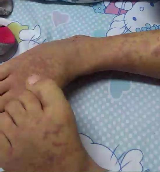 一名儿童被确诊为过敏性紫癜仍在接受治疗。&nbsp;&nbsp;&nbsp;&nbsp; 受访者供图