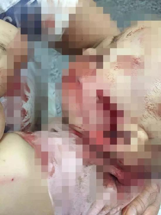 半岁宝宝被恶犬叼走咬穿颅骨