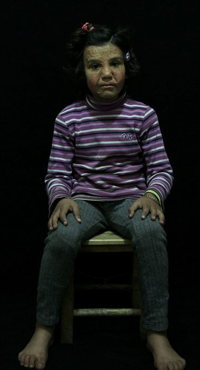一组在叙利亚内战中受伤,随家人逃往土耳其的儿童的照片曝光,画面悲惨