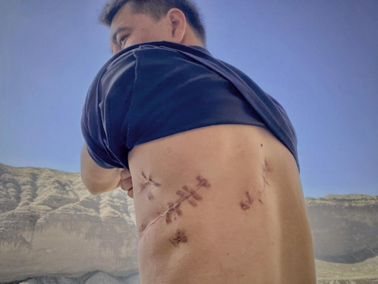 图：迪里夏提向记者展示他身上的伤疤（何卓谦 摄）