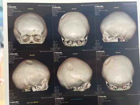 孩子头部右侧顶骨局部凹陷，最深处达0.7厘米。