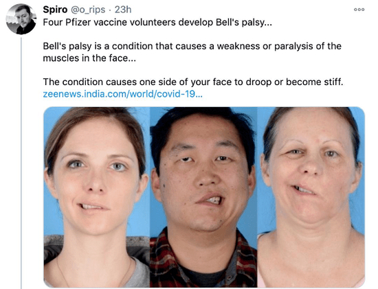 媒体报道了多例接种辉瑞疫苗后出现的面瘫问题