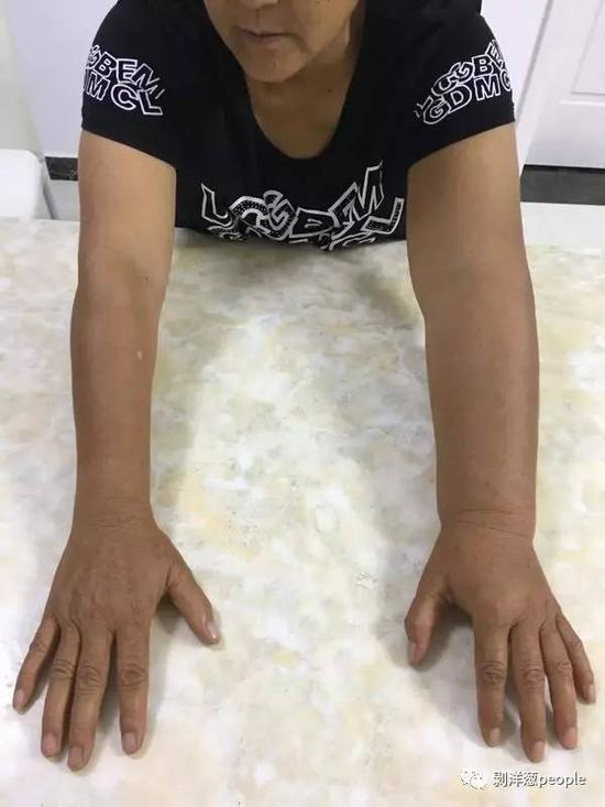 61岁的苏木香，因病导致左臂比右臂粗了一倍，一审被判有期徒刑5年。新京报记者宋超 摄