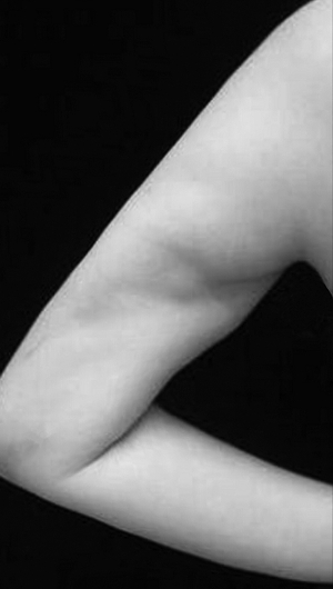  ·莉莉做抽脂手术后，脂肪凹凸明显。图自现代快报。