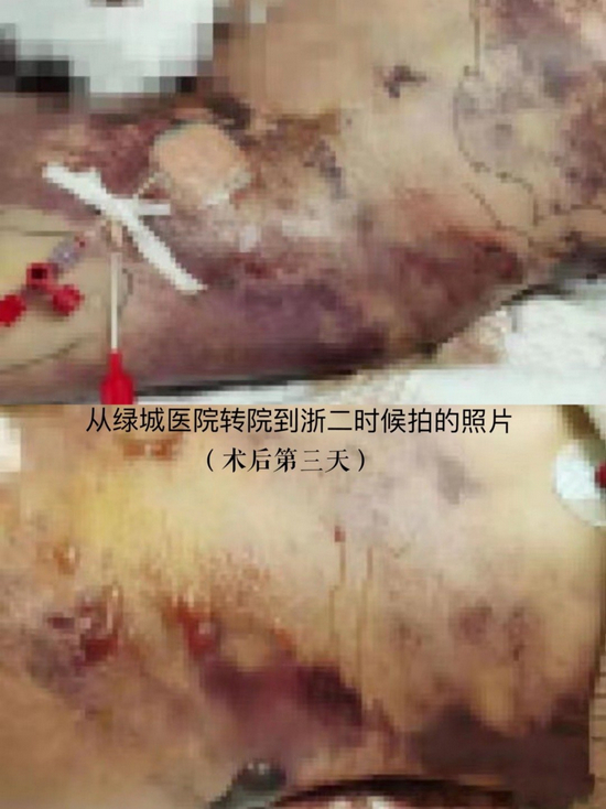 ·被送去抢救时，小冉的皮肤已大面积溃烂、浮肿。图自小冉微博。