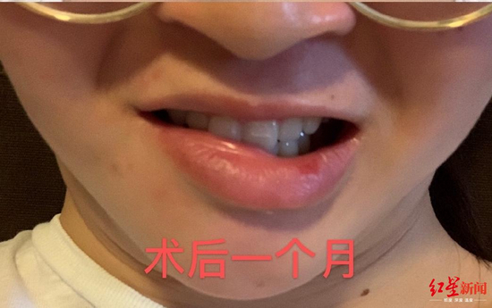  ·蒋女士做完面部抽脂手术后出现面瘫症状。图自红星新闻。