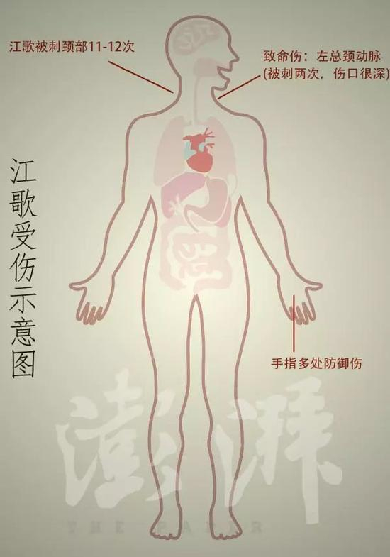 江歌受伤示意图。图/澎湃新闻
