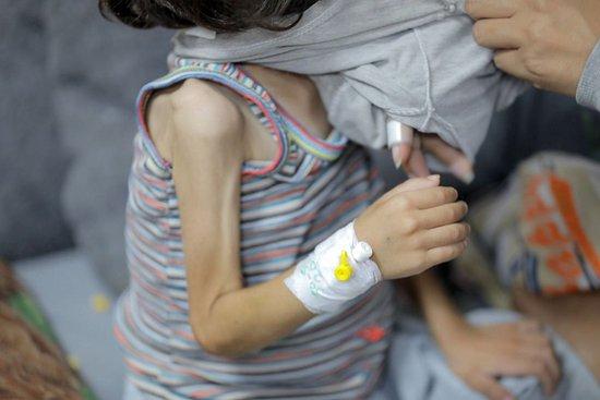 当地时间2024年6月1日，加沙地带代尔拜拉赫，一名患有营养不良的巴勒斯坦儿童在设备有限的阿克萨烈士医院接受治疗。